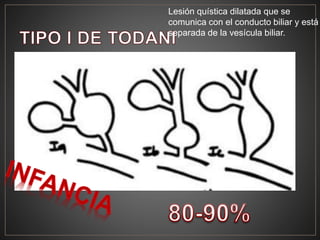 Lesión quística dilatada que se
comunica con el conducto biliar y está
separada de la vesícula biliar.
 