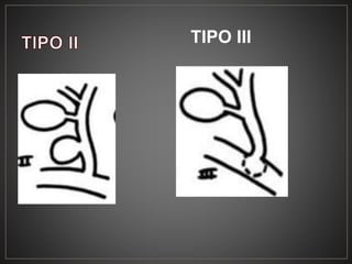 TIPO III
 