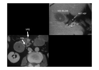 ART HEP
VP
COL
VES BILIAR
VMS
COL
 