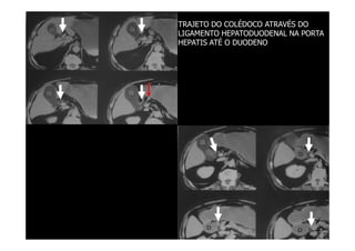 TRAJETO DO COLÉDOCO ATRAVÉS DO
LIGAMENTO HEPATODUODENAL NA PORTA
HEPATIS ATÉ O DUODENO
 