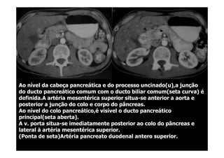 Ao nível da cabeça pancreática e do processo uncinado(u),a junção
do ducto pancreático comum com o ducto biliar comum(seta curva) é
definida.A artéria mesentérica superior situa-se anterior a aorta e
posterior a junção do colo e corpo do pâncreas.
Ao nível do colo pancreático,é visível o ducto pancreático
principal(seta aberta).
A v. porta situa-se imediatamente posterior ao colo do pâncreas e
lateral à artéria mesentérica superior.
(Ponta de seta)Artéria pancreato duodenal antero superior.
 