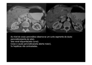 Ao nível do corpo pancreático observa-se um curto segmento do ducto
pancreático(ponta de seta).
Veia renal esquerda(seta curva).
Corpo e cauda pancreática(seta aberta maior).
Vv hepáticas não contrastadas.
 