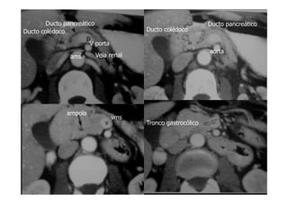 Ducto pancreático
V porta
ams
Ducto colédoco Ducto colédoco
Ducto pancreático
aorta
Veia renal
ampola
vms
Tronco gastrocólico
 