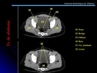 20. Psoas  25. Bexiga 29. Glúteos 30. Reto 32. Ves. Seminais 35. Ureter Tc de abdome Anatomia Radiológica do Abdome 