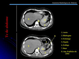 2. Aorta 3. Diafragma 4. Estomago 5. Fígado 6. Esôfago 7. Baço 8. Ang. Esplênico do colon Tc de abdome Anatomia Radiológica do Abdome 