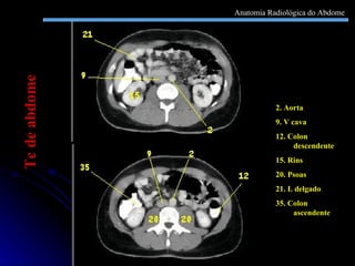 2. Aorta 9. V cava 12. Colon descendente 15. Rins 20. Psoas  21. I. delgado 35. Colon ascendente Tc de abdome Anatomia Radiológica do Abdome 