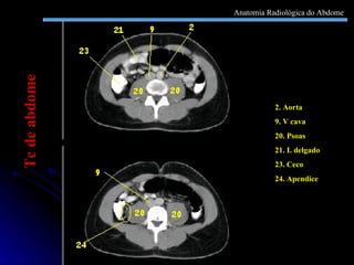 2. Aorta 9. V cava 20. Psoas  21. I. delgado 23. Ceco 24. Apendice Tc de abdome Anatomia Radiológica do Abdome 