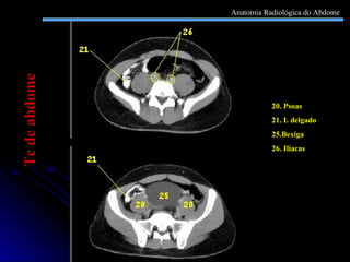 20. Psoas  21. I. delgado 25.Bexiga 26. Ilíacas Tc de abdome Anatomia Radiológica do Abdome 