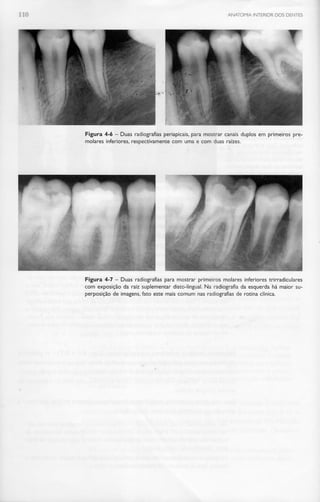 110 ANATOMIA INTERIOR DOS DENTES
Figura 4-6 - Duas radiografias periapicais, para mostrar canais duplos em primeiros pre-
molares inferiores, respectivamente com uma e com duas raízes.
Figura 4-7 - Duas radiografias para mostrar primeiros molares inferiores trirradiculares
com exposição da raiz suplementar disto-lingual. Na radiografia da esquerda há maior su-
perposição de imagens, fato este mais comum nas radiografias de rotina clínica.
 