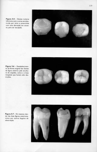 119
Figura 5-5 - Dentes molares
inferiores com a coroasemides-
truída por cárie e preenchida
com cera derretida em exces-
so, para ser esculpida.
Figura 5-6- Restabelecimen-
to da forma original dos dentes
da figura anterior, pela escultu-
ra de cúspides, sulcos e cristas
marginais que haviam sido des-
truídos.
Figura 5-7- Osmesmos den-
tes das duas figuras anteriores,
vistos por outros ângulos de
observação.
 