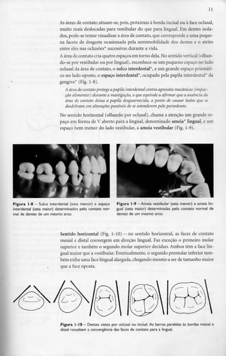 11
As áreas de contato situam-se, pois, próximas à borda incisai ou à face oclusal,
muito mais deslocadas para vestibular do que para lingual. Em dentes isola-
dos, pode-se tentar visualizara área de contato, que corresponde a uma peque-
na faceta de desgaste ocasionada pela semimobilidade dos dentes e o atrito
entre eles nas oclusões* sucessivas durante a vida.
Aárea de contato cria quatro espaços em torno dela.No sentido vertical (olhan-
do-se por vestibular ou por lingual),reconhece-se um pequeno espaçono lado
oclusal da área de contato, o sulco interdental*, e um grande espaço prismáti-
co no lado oposto, o espaço interdental*, ocupado pela papila interdental* da
gengiva* (Fig. 1-8).
A área de contato protege apapila interdental contra agressões mecânicas (impac-
ção alimentar) durante a mastigação, o que equivale a afirmar que a ausência da
área de contato deixa a papila desguarnecida, a ponto de causar lesões que se
desdobram em alteraçõespossíveis de se estenderem pelo periodonto.
No sentido horizontal (olhando por oclusal), chama a atenção um grandees-
paço em forma de V aberto para a lingual, denominado ameia* lingual, e um
espaço bem menor do lado vestibular, a ameia vestibular (Fig.1-9).
Figura 1-8 - Sulco interdental (seta menor) e espaço
interdental (seta maior) determinados pelo contato nor-
mal de dentes de um mesmo arco.
Figura 1-9 -Ameia vestibular (seta menor) e ameia lin-
gual (seta maior) determinadas pelo contato normal de
dentes de um mesmo arco.
Sentido horizontal (Fig. 1-10) - no sentido horizontal, as faces de contato
mesial e distai convergem em direção lingual. Faz exceção o primeiro molar
superior e também o segundo molar superior decíduo. Ambos têm a face lin-
gual maior que a vestibular. Eventualmente,o segundo premolar inferior tam-
bém exibe uma face lingual alargada,chegando mesmo a ser de tamanho maior
que a face oposta.
Figura I-IO - Dentes vistos por oclusal ou incisai. As barras paralelas às bordas mesial e
distai ressaltam a convergência das faces de contato para a lingual.
 