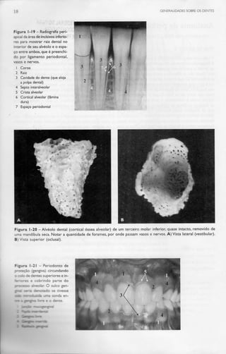 18 GENERALIDADES SOBRE OS DENTES
Figura 1-19 - Radiografia peri-
apical da área de incisivos inferio-
res para mostrar raiz dental no
interior de seu alvéolo e o espa-
ço entre ambos, que é preenchi-
do por ligamento periodontal,
vasos e nervos.
1 Coroa
2 Raiz
3 Cavidade do dente (que aloja
a polpa dental)
4 Septo interalveolar
5 Crista alveolar
6 Cortical alveolar(lâmina
dura)
7 Espaço periodontal
Figura 1-20 -Alvéolo dental (cortical óssea alveolar) de um terceiro molar inferior, quase intacto, removido de
uma mandíbula seca. Notar a quantidade de forames, por onde passam vasos e nervos. A) Vista lateral (vestibular).
B) Vista superior (oclusal).
Figura 1-21 — Periodonto de
protEção (gengiva) circundando
: -: :í :.::.:; :-es e in-
e cobrindo parte do
r. O sulco gen-
- : : -. --.~
 