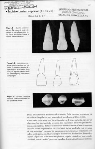 33
Incisivo central superior (11 ou 21)
(Figs. 2-1, 2-2 e 2-3)
Figura 2-1 - Incisivo central su-
perior. Da esquerda para a di-
reita, três exemplaresvistos pe-
las faces vestibular, lingual e
mesial, respectivamente.
UNIVERSIDADE FEDERAL DOPARA
CURSO DE ODONTOLOGIA
FRANCISCO £Ái-M)
Figura 2-2- Incisivos centrale
lateral superiores vistos por ves-
tibular. O terceiro desenho é a
superposição do primeiro (linha
cheia) ao segundo (réplica em li-
nha interrompida), para melhor
comparação.
Figura 2-3- Canino e incisivos
lateral e central superiores vis-
tos pela borda incisai.
Dente absolutamente indispensável na estética facial e o mais importante na
articulação das palavras para a emissão de sons línguo e lábio-dentais.
Como todos os incisivos, tem forma de cunha ou de chave de fenda, para cortar
alimentos. Sua face vestibular apresentadois sulcos rasos de disposiçãocérvico-
incisal, consequência da fusão dos lobos de desenvolvimento. Como nos demais
incisivos recém-erupcionados, ele exibe borda incisai serrilhada, pela presença
de três mamelões*, os quais são pequenas eminências que, à semelhança dos
sulcos vestibulares, constituem vestígios da separação dos lobos de desenvolvi-
mento. Depois que os incisivos completam a erupção e adquirem uma posição
funcional, o uso e a atrição* provocam o gradualdesaparecimentodessas saliências.
 