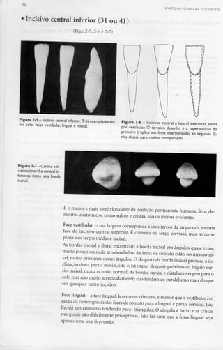 ANATOMIA INDIVIDUAL DOS DENTES
Incisivo central inferior (31 ou 41)
(Figs. 2-5, 2-6 e2-7)
Figura 2-5 —Incisivo central inferior. Três exemplares vis-
tos pelas faces vestibular, lingual e mesial.
Figura 2-6 - Incisivos central e lateral inferiores vistos
por vestibular. O terceiro desenho é a superposição do
primeiro (réplica em linha interrompida) ao segundo (li-
nha cheia), para melhor comparação.
Figura 2-7 —Canino e in-
cisivos lateral e central in-
feriores vistos pela borda
incisai.
É o menor e mais simétrico dente da dentição permanente humana. Seus ele-
mentos anatómicos, como sulcos e cristas, são os menos evidentes.
Face vestibular - sualargura corresponde a dois terços da largura da mesma
face do incisivo central superior. É convexa no terço cervical, mas torna-se
plana nos terços médio e incisai.
As bordas mesial e distai encontram a borda incisai em ângulos quase retos,
muito pouco ou nada arredondados. As áreas de contato estão no mesmo ní-
vel, muito próximas desses ângulos. O desgaste da borda incisai provoca a in-
clinação desta para a mesial, isto é, há maior desgaste próximo ao ângulo mé-
sio-incisal, numa oclusão normal. As bordas mesial e distai convergempara o
colo mas não muito acentuadamente;elas tendem ao paralelismomais do que
em qualquer outro incisivo.
Face lingual - a face lingual, levemente côncava,é menor que a vestibularem
razão da convergênciadas faces de contato para a lingual e para a cervical.Isto
lhe dá um contorno tendendo para triangular. O cíngulo é baixo e as cristas
marginais são dificilmente perceptíveis. Isto faz com que a fossa lingual seja
apenas uma leve depressão.
 