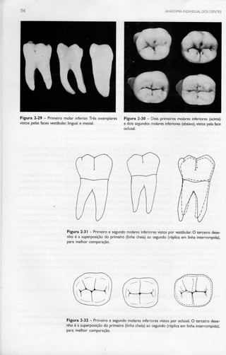 ANATOMIA INDIVIDUAL DOS DENTES
Figura 2-29 - Primeiro molar inferior. Três exemplares
vistos pelas faces vestibular, lingual e mesial.
Figura 2-30 - Dois primeiros molares inferiores (acima)
e dois segundos molares inferiores (abaixo), vistos pela face
oclusal.
Figura 2-31 - Primeiro e segundo molares inferiores vistos por vestibular. O terceiro dese-
nho é a superposição do primeiro (linha cheia) ao segundo (réplica em linha interrompida),
para melhor comparação.
Figura 2-32 - Primeiro e segundo molares inferiores vistos por oclusal. O terceiro dese-
nho é a superposição do primeiro (linha cheia) ao segundo (réplica em linha interrompida),
para melhor comparação.
 
