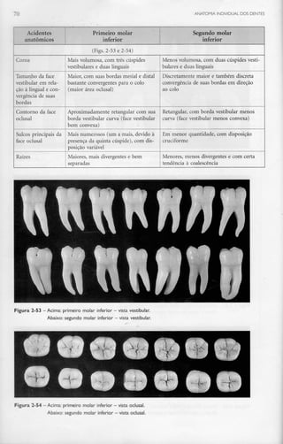 70 ANATOMIA INDIVIDUAL DOS DENTES
Acidentes
anatómicos
Primeiro molar
inferior
Segundo molar
inferior
(Figs. 2-53 e 2-54)
Coroa
Tamanho da face
vestibular em rela-
ção à lingual e con-
vergência de suas
bordas
Contorno da face
oclusal
Sulcos principais da
face oclusal
Raízes
Mais volumosa, com três cúspides
vestibulares e duas linguais
Maior, com suas bordas mesial e distai
bastante convergentes para o colo
(maior área oclusal)
Aproximadamente retangular com sua
borda vestibular curva (face vestibular
bem convexa)
Mais numerosos (um a mais, devido à
presença da quinta cúspide), com dis-
posição variável
Maiores, mais divergentes e bem
separadas
Menos volumosa, com duas cúspides vesti-
bulares e duas linguais
Discretamente maior e também discreta
convergência de suas bordas em direção
ao colo
Retangular, com borda vestibular menos
curva (face vestibular menos convexa)
Em menor quantidade, com disposição
cruciforme
Menores, menos divergentes e com certa
tendência à coalescência
Figura 2-53 -Acima: primeiro molar inferior - vista vestibular.
Abaixo: segundo molar inferior - vista vestibular.
Figura 2-54 - Acima: primeiro molar inferior - vista oclusal.
Abaixo: segundo molar inferior - vista oclusal.
 