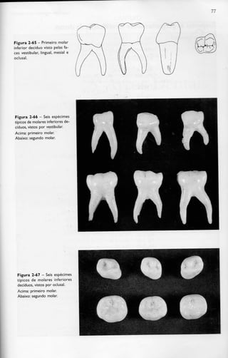 77
Figura 2-65 - Primeiro molar
inferior decíduo visto pelas fa-
ces vestibular, lingual, mesial e
oclusal.
Figura 2-66 - Seis espécimes
típicos de molares inferiores de-
cíduos, vistos por vestibular.
Acima: primeiro molar.
Abaixo: segundo molar.
Figura 2-67 - Seis espécimes
típicos de molares inferiores
decíduos, vistos por oclusal.
Acima: primeiro molar.
Abaixo: segundo molar.
 