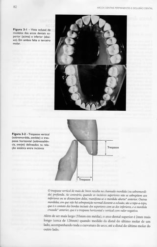 ARCOS DENTAIS PERMANENTES E OCLUSÃO DENTAL
Figura 3-1 -Vista oclusal de
modelos dos arcos dentais su-
perior (acima) e inferior (abai-
xo). Em ambos falta o terceiro
molar.
Figura 3-2 -Trespasse vertical
(sobremordida, overbite) e tres-
passe horizontal (sobressaliên-
cia, overjet) delineados na rela-
ção estática entre incisivos
"TC
Trespasse
Trespasse
O trespasse vertical de mais de 3mm resulta na chamada mordida (ou sobremordi-
da) profunda. Ao contrário, quando os incisivos superiores não se sobrepõem aos
inferiores ou se distanciam deles, manifesta-se a mordida aberta* anterior. Outras
mordidas, em que não há sobreposição normal durante a oclusão,são a topo-a-topo,
que é o contato das bordas incisais dos superiorescom as dos inferiores, e a mordida
cruzada* anterior, que é o trespasse horizontal e vertical com valor negativo.
Além de ser mais largo (55mm em média), o arco dental superior é 2mm mais
longo (cerca de 128mm) quando medido da distai do último molar de um
lado, acompanhando toda a curvatura do arco, até a distai do último molar do
outro lado.
 
