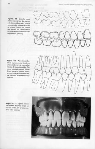 -- ARCOS DENTAIS PERMANENTES E OCLUSÃO DENTAL
Figura 3-10 - Desenho esque-
mático das coroas dos dentes,
pela face vestibular, para mostrar
como se dá o encaixe recíproco
na: oclusão (acima). Os contor-
nos normais das coroas dentais
foram acrescentadosao desenho
esquemático (abaixo).
Figura 3-11- Aspecto vestibu-
lar do engrenamento dental em
uma oclusão normal, com os he-
miarcos direitos distendidos.Ob-
servar a oclusão de dois dentes
de um hemiarco com um do ou-
tro, com exceção do incisivocen-
tral inferior e do terceiro molar
superior.
Figura 3-12- Aspecto anterior
de modelos de arcos dentais em
oclusão central. Os terceiros mo-
lares estão ausentes.
^' s,-' ' N /
/v
-^ /  N -^
^ )C A
*— _r l
  x
A
/  / 
! l 

 