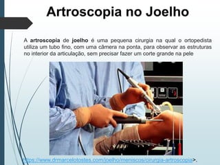 Artroscopia no Joelho
A artroscopia de joelho é uma pequena cirurgia na qual o ortopedista
utiliza um tubo fino, com uma câmera na ponta, para observar as estruturas
no interior da articulação, sem precisar fazer um corte grande na pele
https://www.drmarcelotostes.com/joelho/meniscos/cirurgia-artroscopia>.
 
