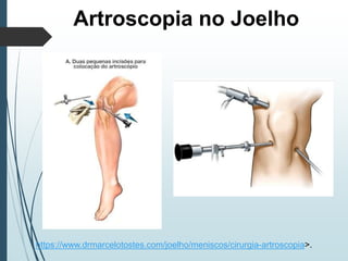 Artroscopia no Joelho
https://www.drmarcelotostes.com/joelho/meniscos/cirurgia-artroscopia>.
 