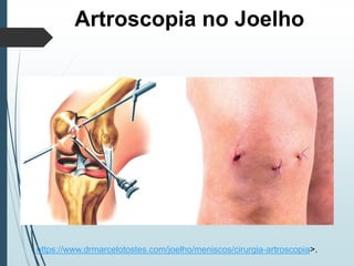 Artroscopia no Joelho
https://www.drmarcelotostes.com/joelho/meniscos/cirurgia-artroscopia>.
 