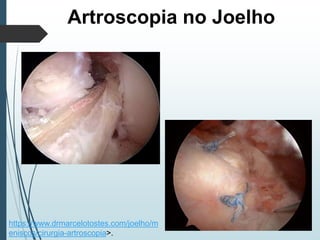 Artroscopia no Joelho
https://www.drmarcelotostes.com/joelho/m
eniscos/cirurgia-artroscopia>.
 