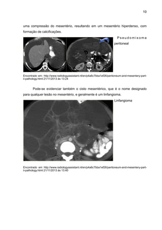 10

uma compressão do mesentério, resultando em um mesentério hiperdenso, com
formação de calcificações.
Pseudomixoma
peritoneal

"
"
"
"
"

Encontrado em: http://www.radiologyassistant.nl/en/p4a6c7bba1ef26/peritoneum-and-mesentery-partii-pathology.html 21/11/2013 às 13:24

"

Pode-se evidenciar também o cisto mesentérico, que é o nome designado
para qualquer lesão no mesentério, e geralmente é um linfangioma.
Linfangioma 

"
"
"
"
"
"
"
"
"
"
"
"
"
"
"

Encontrado em http://www.radiologyassistant.nl/en/p4a6c7bba1ef26/peritoneum-and-mesentery-partii-pathology.html 21/11/2013 às 13:40

"
"
"
"
"
"
"
"
"

 