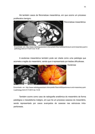 11

Há também casos de fibromatose mesentérica, em que ocorre um processo
proliferativo benigno.
Fibromatose mesentérica 

"
"
"
"
"
"

Encontrado em http://www.radiologyassistant.nl/en/p4a6c7bba1ef26/peritoneum-and-mesentery-part-iipathology.html 21/11/2013 às 14:30

A esclerose mesentérica também pode ser citada como uma patologia que
acomete a região do mesentério, sendo que é representada por lesões dificultosas.
Esclerose

"
"
"
"
"
"
Encontrado em http://www.radiologyassistant.nl/en/p4a6c7bba1ef26/peritoneum-and-mesentery-partii-pathology.html 21/11/2013 às 14:30

"

Também ocorre como caso de radiografia anatômica do mesentério de forma
patológica o mesotelioma maligno, em que há um processo caseoso do mesentério,
sendo representado por casos avançados de caseose nas estruturas intraperitoneais.

 