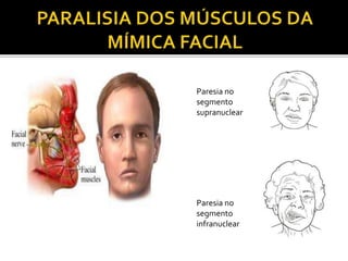 Paresia no
segmento
infranuclear
Paresia no
segmento
supranuclear
 