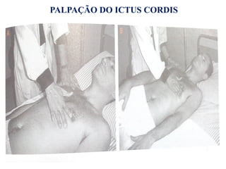 PALPAÇÃO DO ICTUS CORDIS
 