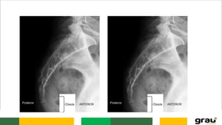 Anatomia da caixa toráxica e coluna vertebral