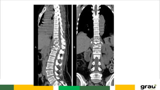 Anatomia da caixa toráxica e coluna vertebral