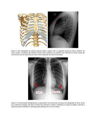 Figura 3. Nas radiografias em perfil é possível avaliar o esterno (E) e o segmento dorsal da coluna vertebral. Os
arcos costais e escápulas são também visíveis nesta incidência. As porções mais inferiores da coluna dorsal são
mais escuras que as superiores por haver menor absorção dos raios-X nas bases.




Figura 4. As hemicúpulas diafragmáticas se apresentam como estruturas convexas nas radiografias do tórax, sendo
que a direita tem posição mais alta na maioria dos indivíduos. À direita o diafragma é contíguo ao fígado, enquanto à
esquerda pode-se identificar o estômago pela presença de ar em seu interior.
 