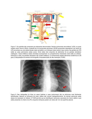 Figura 7. Os pulmões são compostos por elementos denominados “lobulos pulmonares secundários” (LPS), os quais
medem entre 10mm e 25mm, contendo de 3-5 bronquíolos terminais e 30-50 bronquíolos respiratórios. No centro do
LPS encontram-se uma artéria lobular (seta vermelha) e um brônquio (seta verde) e seus ramos. Na perifeira do LPS
estão as veias pulmonares (setas azuis). Entre estes dois conjuntos de elementos há as paredes alveolares
(retângulo). Vasos linfáticos (setas amarelas) acompanham os compatimentos intersticiais onde estão as artérias,
brônquios e veias. As paredes alveolares não contém linfáticos. O conhecimento destes elementos anatômicos é útil
para a interpretação de exames de tomografia computadorizada de alta resolução (TCAR).




Figura 8. Nas radiografias do tórax os vasos (artérias e veias pulmonares) são as estruturas mais facilmente
identificadas. Apenas os brônquios de maior calibre são visíveis radiograficamente. As demais estruturas estão
abaixo da resolução do método. A TCAR permite que se identifiquem estruturas vasculares de menor calibre e que
estão presentes no interior do LPS, enquanto brônquios podem ver vistos até 1cm da superfície pleural.
 
