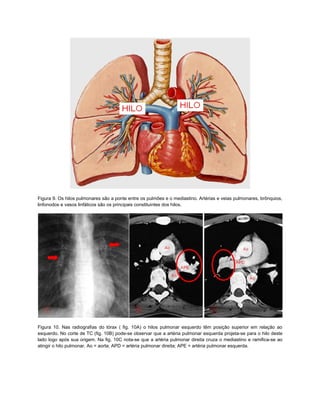 Figura 9. Os hilos pulmonares são a ponte entre os pulmões e o mediastino. Artérias e veias pulmonares, brônquios,
linfonodos e vasos linfáticos são os principais constituintes dos hilos.




Figura 10. Nas radiografias do tórax ( fig. 10A) o hilos pulmonar esquerdo têm posição superior em relação ao
esquerdo. No corte de TC (fig. 10B) pode-se observar que a artéria pulmonar esquerda projeta-se para o hilo deste
lado logo após sua origem. Na fig. 10C nota-se que a artéria pulmonar direita cruza o mediastino e ramifica-se ao
atingir o hilo pulmonar. Ao = aorta; APD = artéria pulmonar direita; APE = artéria pulmonar esquerda.
 