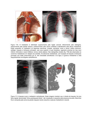 Figura 11A. O mediastino é delimitado superiormente pela região cervical, inferiormente pelo diafragma,
anteriormente pela parede torácica, posteriormente pela coluna vertebral e lateralmente pela pleura mediastinal.
Estão presentes no mediastino as seguintes estruturas: coração, pericárdio, aorta e ramos, artéria pulmonar,
esôfago, traqueia e brônquios principais, veia cava superior e suas tributárias, segmento proximal da veia cava
inferior, linfonodos e vasos linfáticos, nervos, tecido adiposo. Nas radiografias simples (fig. 11B) são observados os
contornos mediastinais em relação aos pulmões. As estruturas mediastinais, com exceção da traqueia e brônquios
principais que estão preenchidos por ar, têm densidade semelhante à da água. A gordura mediastinal é vista
frequentemente nos ângulos cardiofrênicos.




Figura 12. A traqueia cruza o mediastino verticalmente. Estas imagens mostram que, à direita da traqueia, há uma
faixa regular denominada “linha paratraqueal direita”, não visualizada à esquerda pela presença da aorta. Esta linha
fina é composta pela soma da parede traqueal, tecido conjuntivo e pleuras mediastinal e visceral.
 