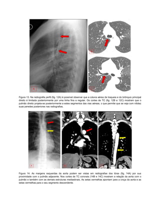 Figura 13. Na radiografia perfil (fig. 12A) é possível observar que a coluna aérea da traqueia e do brônquio principal
direito é limitada posteriormente por uma linha fina e regular. Os cortes de TC (fig. 12B e 12C) mostram que o
pulmão direito projeta-se posteriormente a estes segmentos das vias aéreas, o que permite que se veja com nitidez
suas peredes posteriores nas radiografias.




Figura 14. As margens esquerdas da aorta podem ser vistas em radiografias dos tórax (fig. 14A) por sua
proximidade com o pulmão adjacente. Nos cortes de TC coronais (14B e 14C) mostram a relação da aorta com o
pulmão e também com as demais estruturas mediastinais. As setas vermelhas apontam para a croça da aorta e as
setas vermelhas para o seu segmento descendente.
 