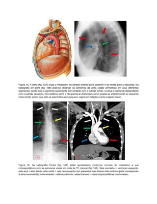 Figura 15. A aorta (fig. 15A) cruza o mediastino no sentido anterior para posterior e da direita para a esquerda. Na
radiografia em perfil (fig. 15B) pode-se observar os contornos da aorta (setas vermelhas) em seus diferentes
segmentos, sendo que o segmento ascendente tem contacto com o pulmão direito, a croça e segmento descendente
com o pulmão esquerdo. Na incidência perfil o hilo pulmonar direito (seta azul) projeta-se anteriormente ao esquerdo
(seta verde), sendo que este se assemelha a um pequeno cajado em relação à aorta (cajado maior).




Figura 16. Na radiografia frontal (fig. 16A) estão apontadados contornos normais do mediastino e sua
correspondência com as estruturas vistas em corte de TC coronal (fig. 16B). Seta vermelha = ventriculo esquerdo;
seta azul = átrio direito; seta verde = veia cava superior (em pacientes mais idosos este contorno pode corresponder
à aorta ascendente); seta amarela = artéria pulmonar; setas brancas = veias braquiocefálicas (inominadas).
 