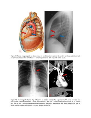 Figura 17. Nestas imagens pode-se observar que no perfil o contorno anterior da sombra cardíaca está relacionada
ao ventrícuo direito (setas vermelhas) e o contorno posterior ao átrio esquerdo (setas azuis).




Figura 18. Na radiografia frontal (fig. 18A) entre os botões aórtico (Ao) e pulmonar (AP) pode ser vista uma
concavidade que está relacionada à janela aortopulmonar (JAP). Ver a correspondência com o corte de TC coronal
(fig. 18B). A JAP é limitada medialmente pelo ligamento arterioso e lateralmente pela pleura visceral. Na JAP há
tecido adiposo, cadeia de linfonodos e o nervo laringeo recurrente.
 