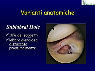 Varianti anatomiche 10% dei soggetti labbro glenoideo  distaccato  prossimalmente Sublabral Hole 