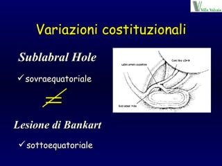 Variazioni costituzionali sovraequatoriale  Sublabral Hole Lesione di Bankart sottoequatoriale  = 