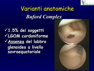 Varianti anatomiche 1.5% dei soggetti LGOM cordoniforme Assenza  del labbro  glenoideo a livello  sovraequatoriale Buford Complex 