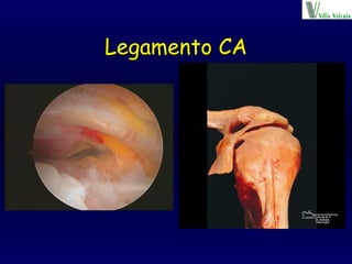Legamento CA 