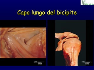 Capo lungo del bicipite 