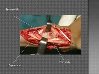 Intermédio




               Profundo
 Superficial
 