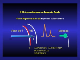 VetorRepresentativo da Isquemia Endocárdica
Eletrodo
+_
Vetor de T VE
OEletrocardiograma na Isquemia Aguda
T + AMPLITUDE AUMENTADA
PONTIAGUDA
SIMÉTRICA
 