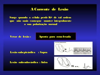 A Corrente de Lesão
Surge quando a célula perde K+ de tal ordem
que não mais consegue manter integralmente
a sua polarização normal
Vetor de lesão : Aponta para zona lesada
Lesão subepicárdica : Supra
Lesão subendocárdica : Infra
 