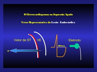 VetorRepresentativo da Lesão Endocárdica
Vetor de ST VE
80mseg
Eletrodo
OEletrocardiograma na Isquemia Aguda
_
+
 