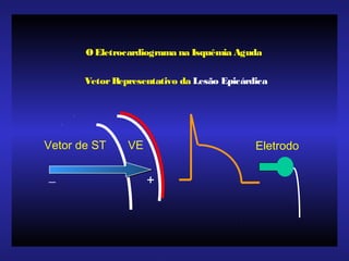 VetorRepresentativo da Lesão Epicárdica
Eletrodo
+
_
Vetor de ST VE
OEletrocardiograma na Isquêmia Aguda
 